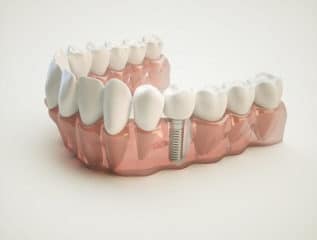 Dental Implants