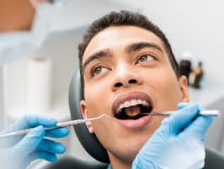 Composite Dental Fillings